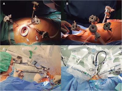 Closed-chest robotic repair of mitral prolapse. Surgical technique and early results